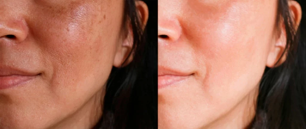 Resultado real - antes e depois