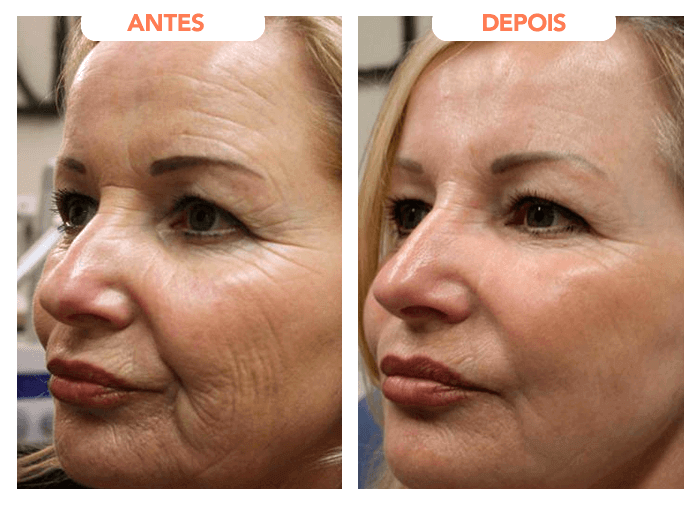 Resultado real - antes e depois